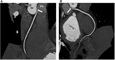 Case Report: Neo-ostium creation with saphenous vein in a patient with anomalous origin of the right coronary artery